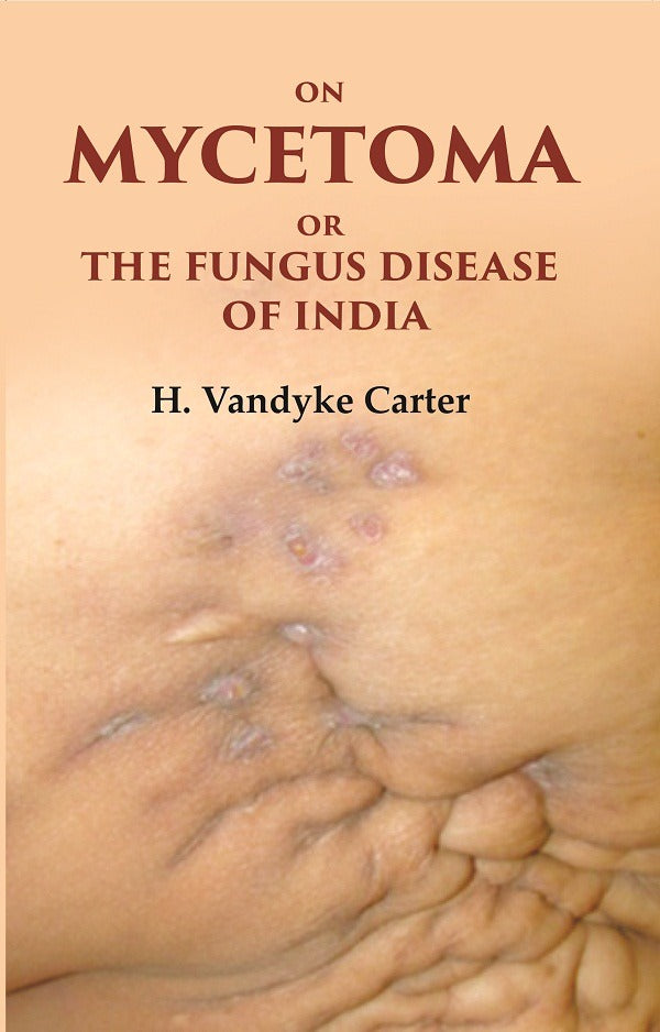 On Mycetoma or the Fungus Disease of India - Gyan Books