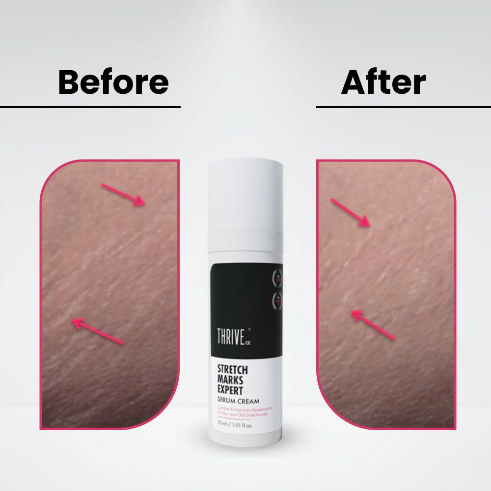 ThriveCo Stretch Marks Expert Serum Cream - Swadesiicart