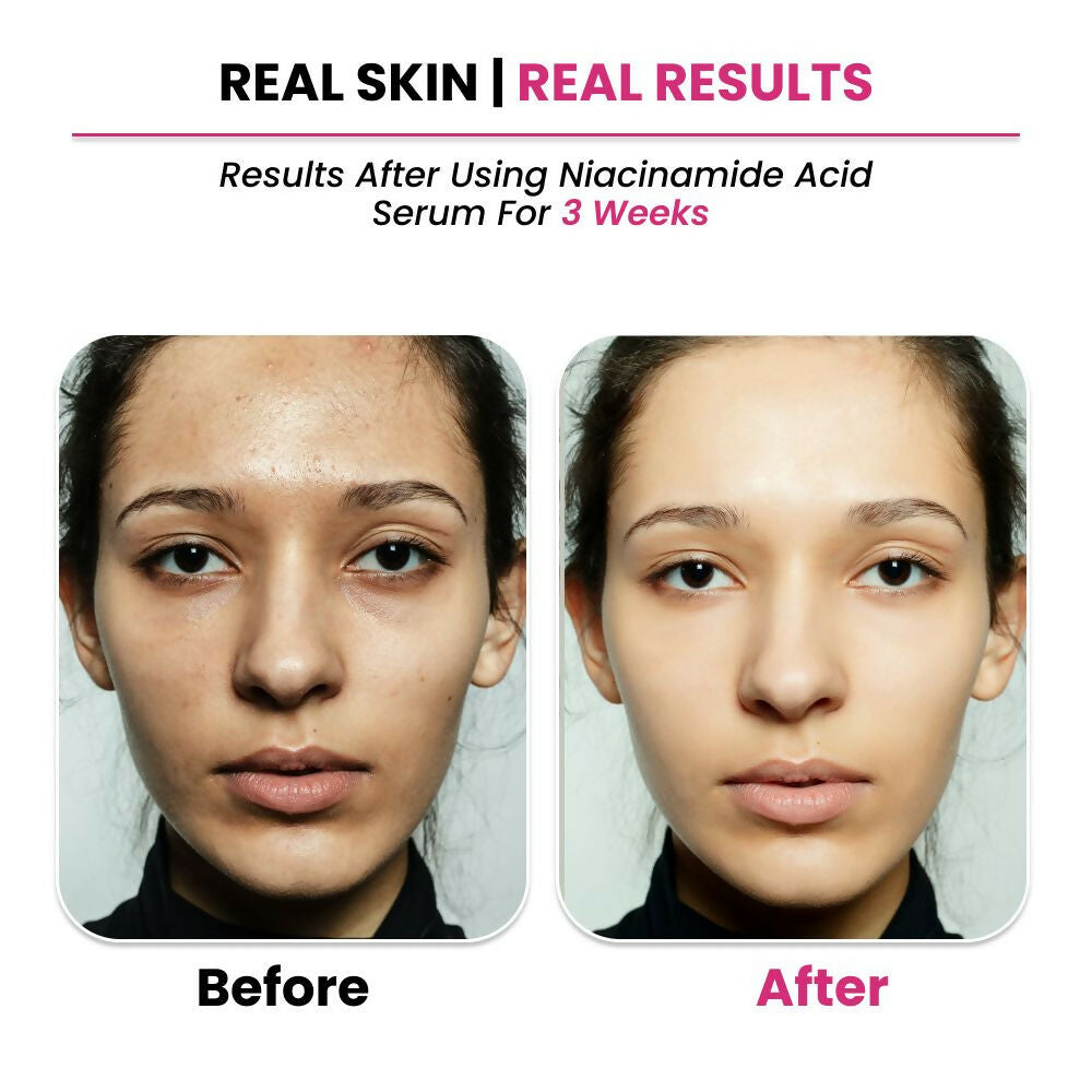 Thriveco 10% Niacinamide + 1% Zinc Pca Serum | Swadesiicart