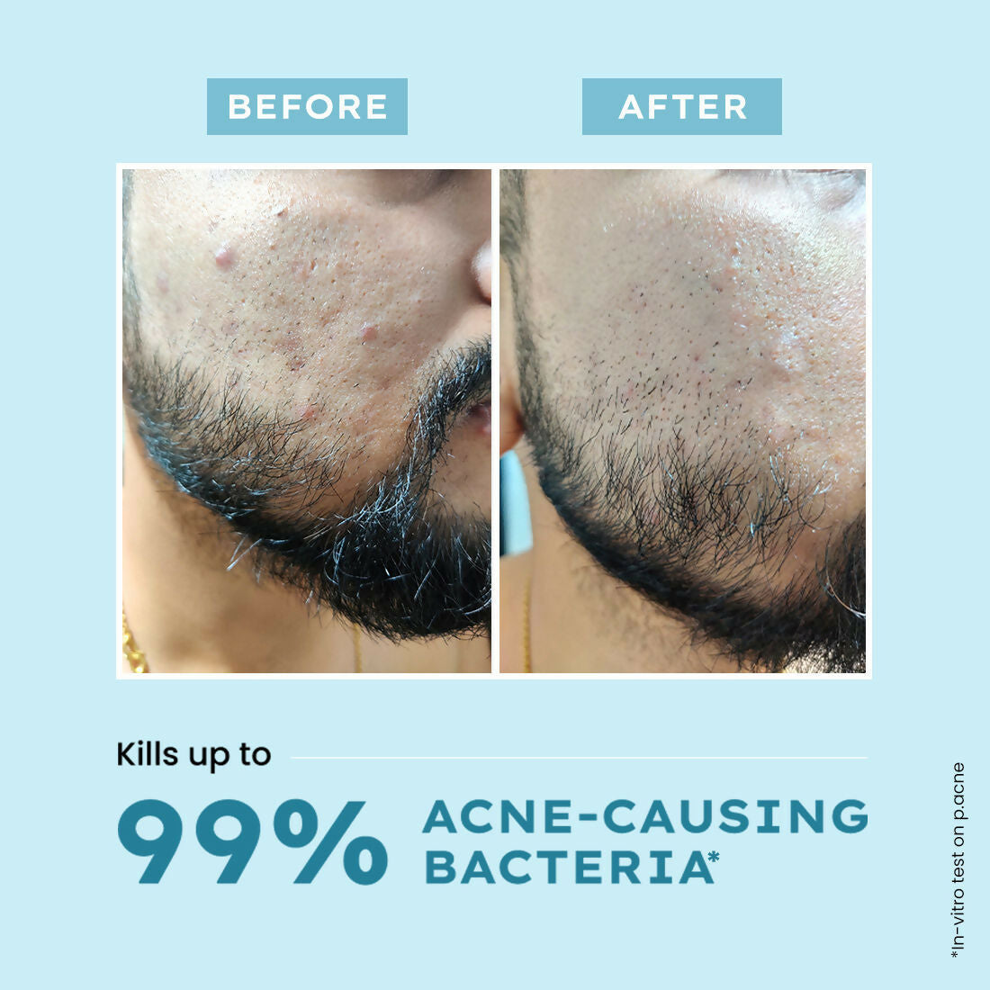 Hyphen By Kriti Sanon Acne Defence Daily Serum With 2% Salicylic Acid For Active Acne & Breakouts | Swadesiicart