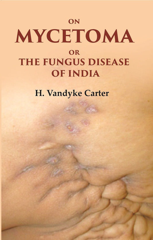 On Mycetoma or the Fungus Disease of India - Gyan Books - Swadesiicart