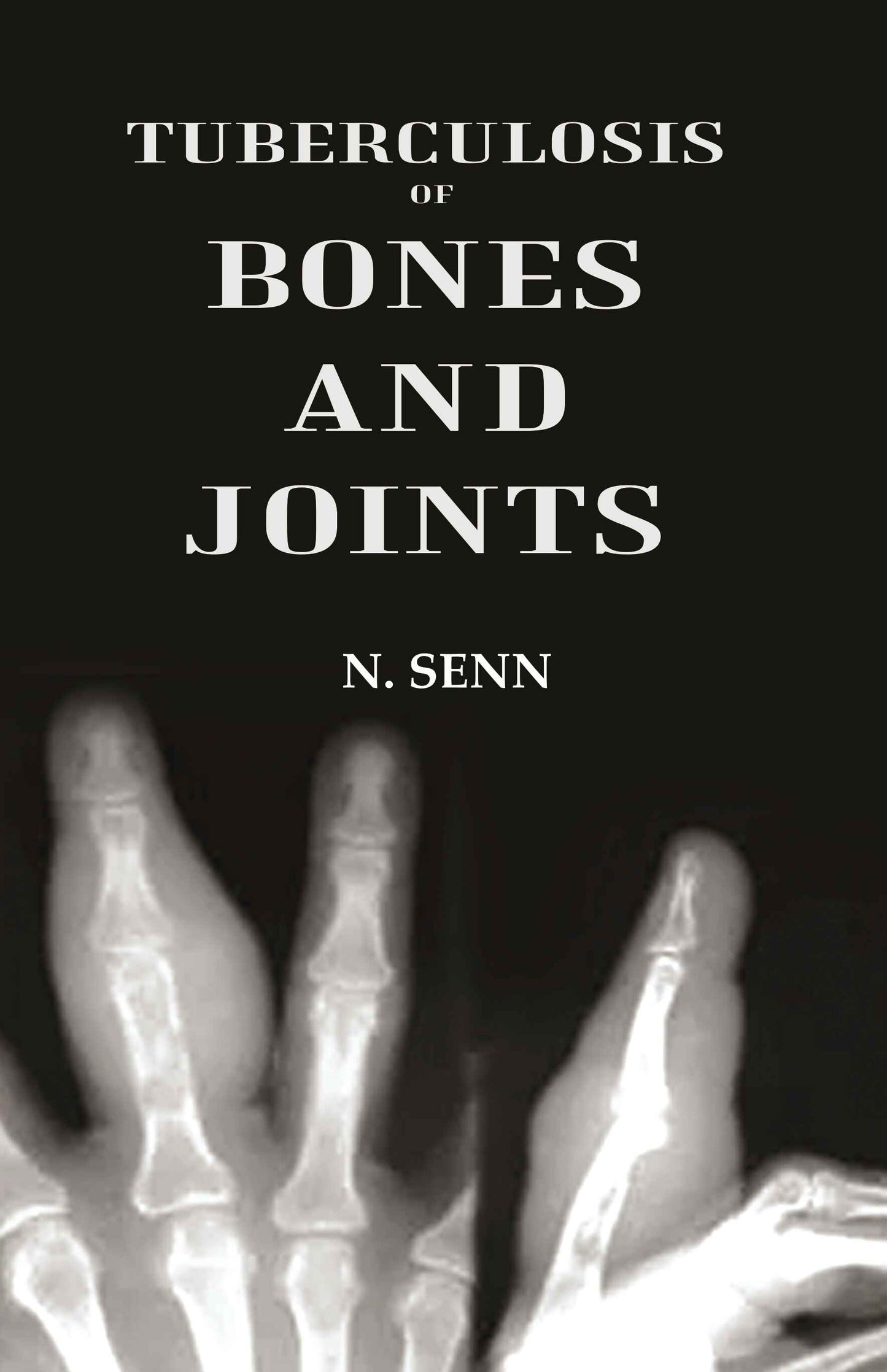 Tuberculosis of Bones and Joints - Gyan Books - Swadesiicart
