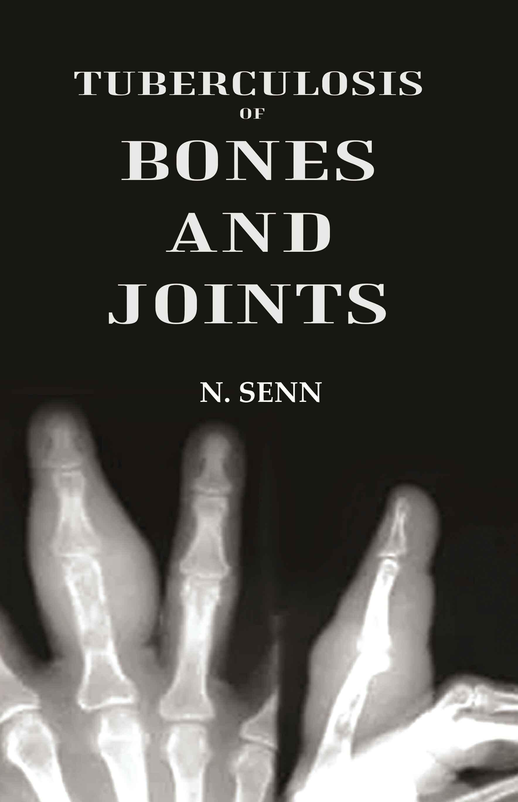 Tuberculosis of Bones and Joints - Gyan Books - Swadesiicart