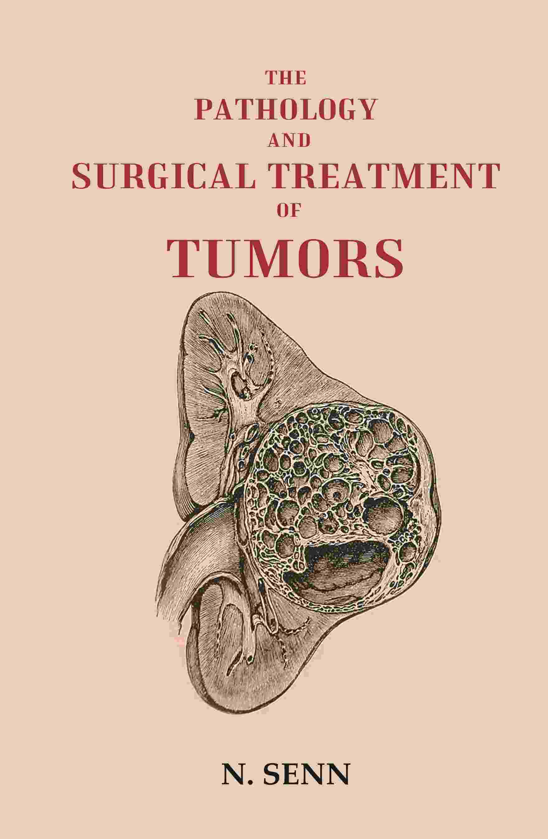The Pathology and Surgical Treatment of Tumors - Gyan Books - Swadesiicart