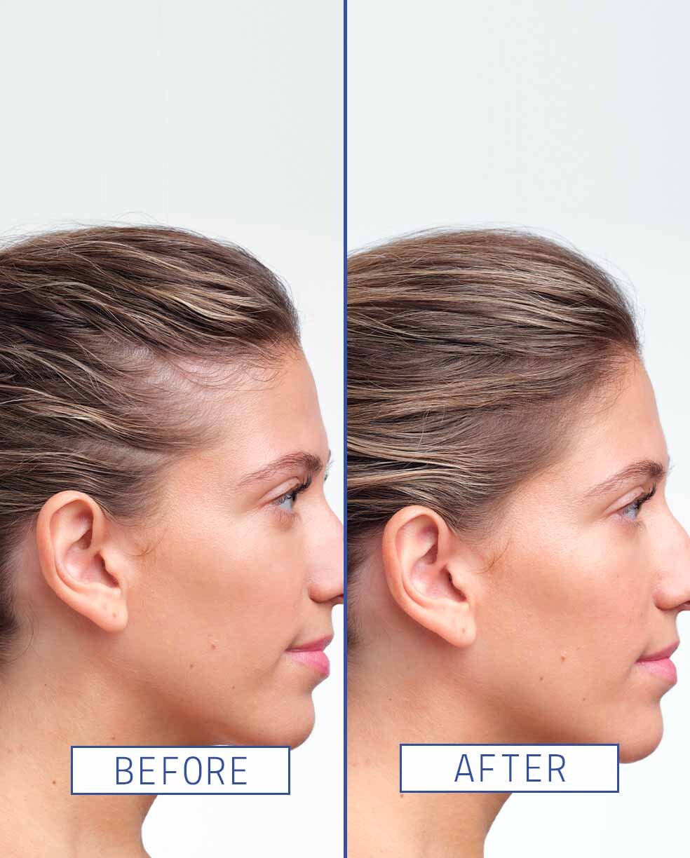 Hair Density Boosting Treatment
