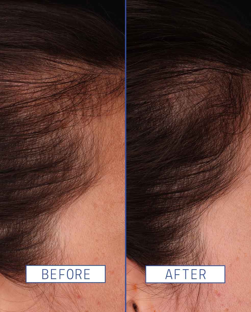 Hair Density Boosting Treatment