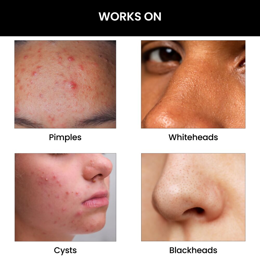 ThriveCo Goodbye Acne Cleanser | Swadesiicart