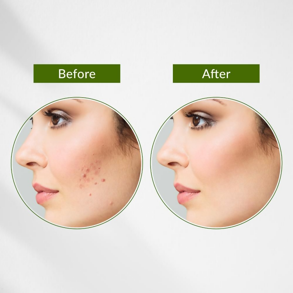 Lotus Botanicals Neem, Tulsi & Salicylic Acid Anti-Acne Purifying Face Gel | Swadesiicart
