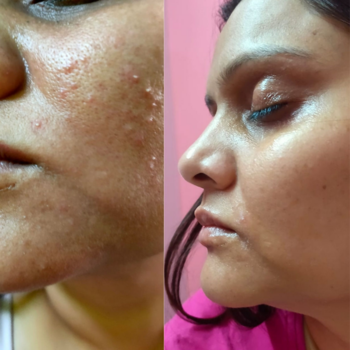 House of Beauty Acne Drying Serum - Swadesiicart