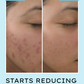 Hyphen By Kriti Sanon Acne Defence Daily Serum With 2% Salicylic Acid Treats Active Acne Prevents Breakouts | Swadesiicart