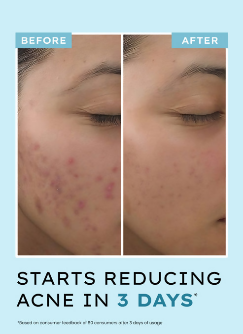 Hyphen By Kriti Sanon Acne Defence Daily Serum With 2% Salicylic Acid Treats Active Acne Prevents Breakouts | Swadesiicart
