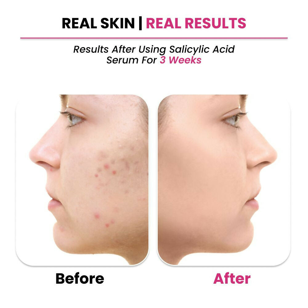 ThriveCo 2% Salicylic acid Serum | Swadesiicart