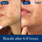 Bake Acne Erase XL Pimple Patches & Nose Patches | Swadesiicart