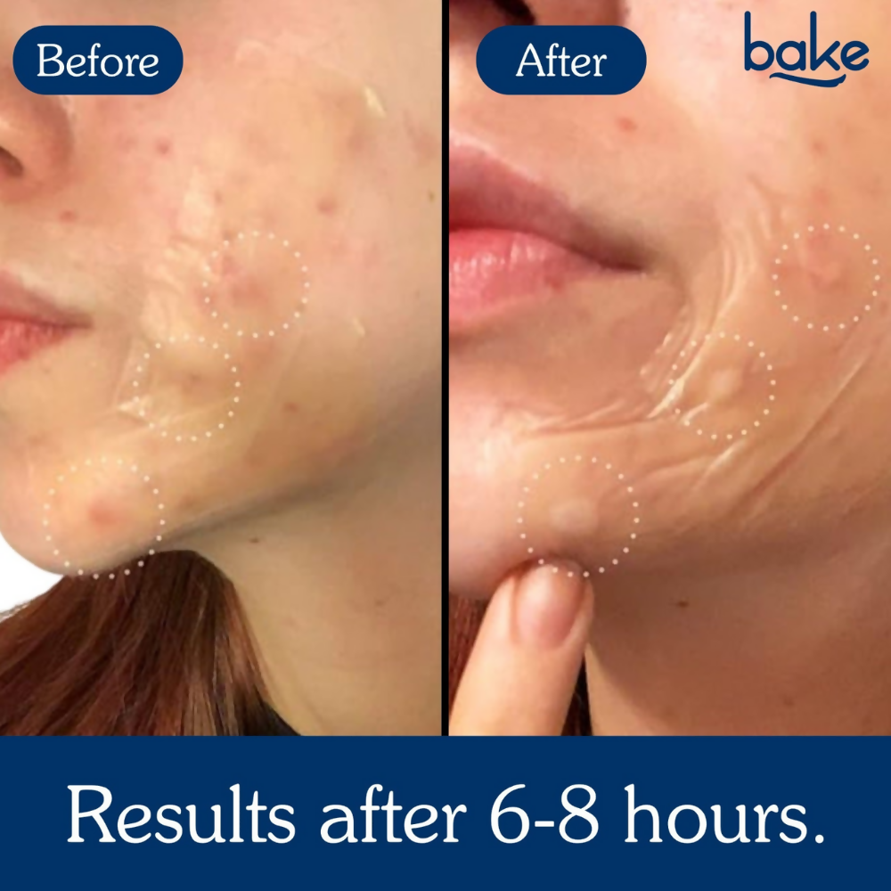 Bake Acne Erase XL Pimple Patches & Nose Patches | Swadesiicart