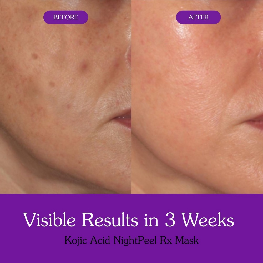 Bake Kojic Acid + Turmeric NightPeel Rx Mask | Swadesiicart