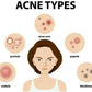 Ipca Acne UV Gel SPF 50 | Swadesiicart