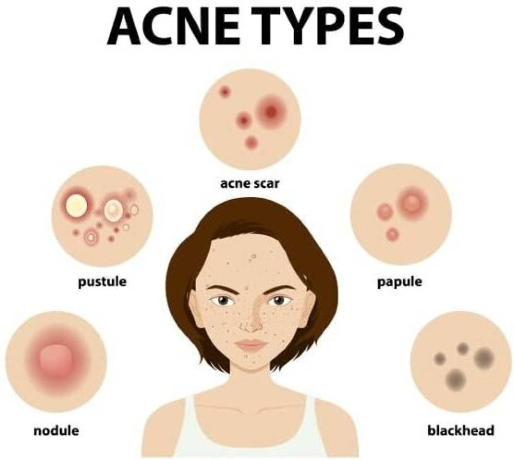 Ipca Acne UV Gel SPF 50 | Swadesiicart