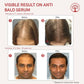 Ivory Natural Bald Serum For Baldness, Hair Thinning And Hair Fall | Swadesiicart