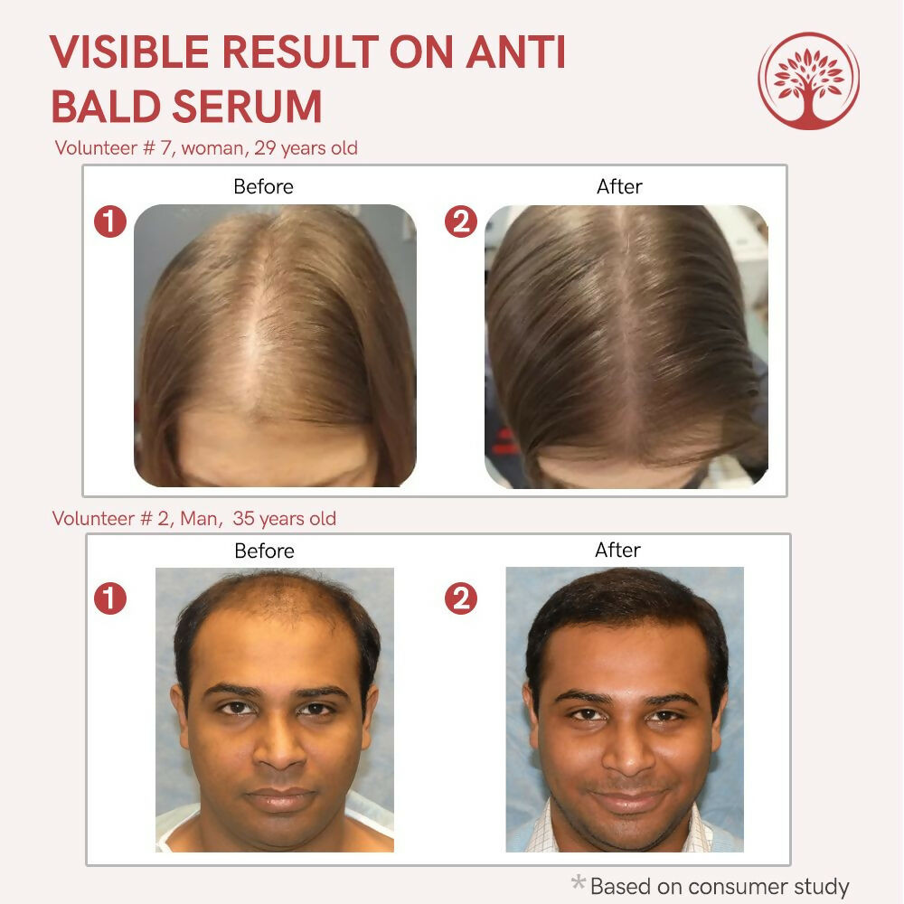 Ivory Natural Bald Serum For Baldness, Hair Thinning And Hair Fall | Swadesiicart