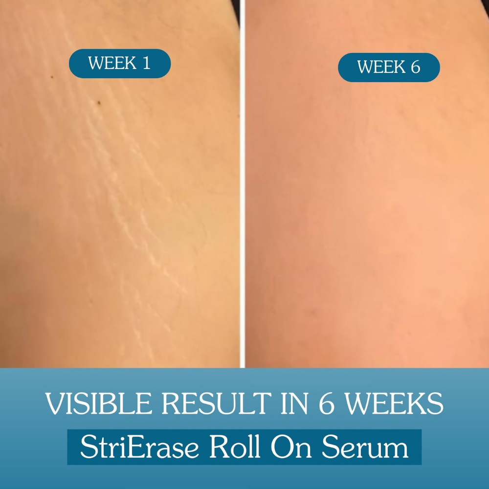 Bake StriErase™ Stretch Marks Removal Roll-On Serum | Swadesiicart