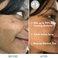mCaffeine 1% Salicylic Acid 1% Succinic Acid & Matcha Tea Acne Arrest Spot Corrector - Treats Active Acne - Swadesiicart