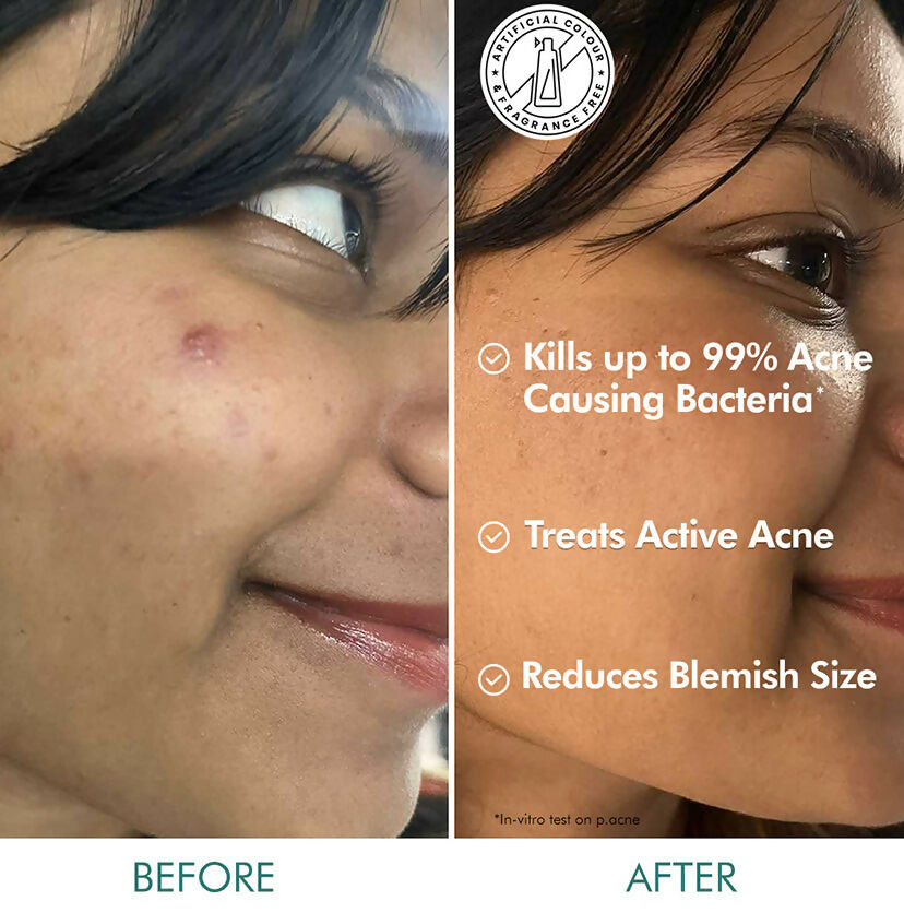 mCaffeine 1% Salicylic Acid 1% Succinic Acid & Matcha Tea Acne Arrest Spot Corrector - Treats Active Acne - Swadesiicart