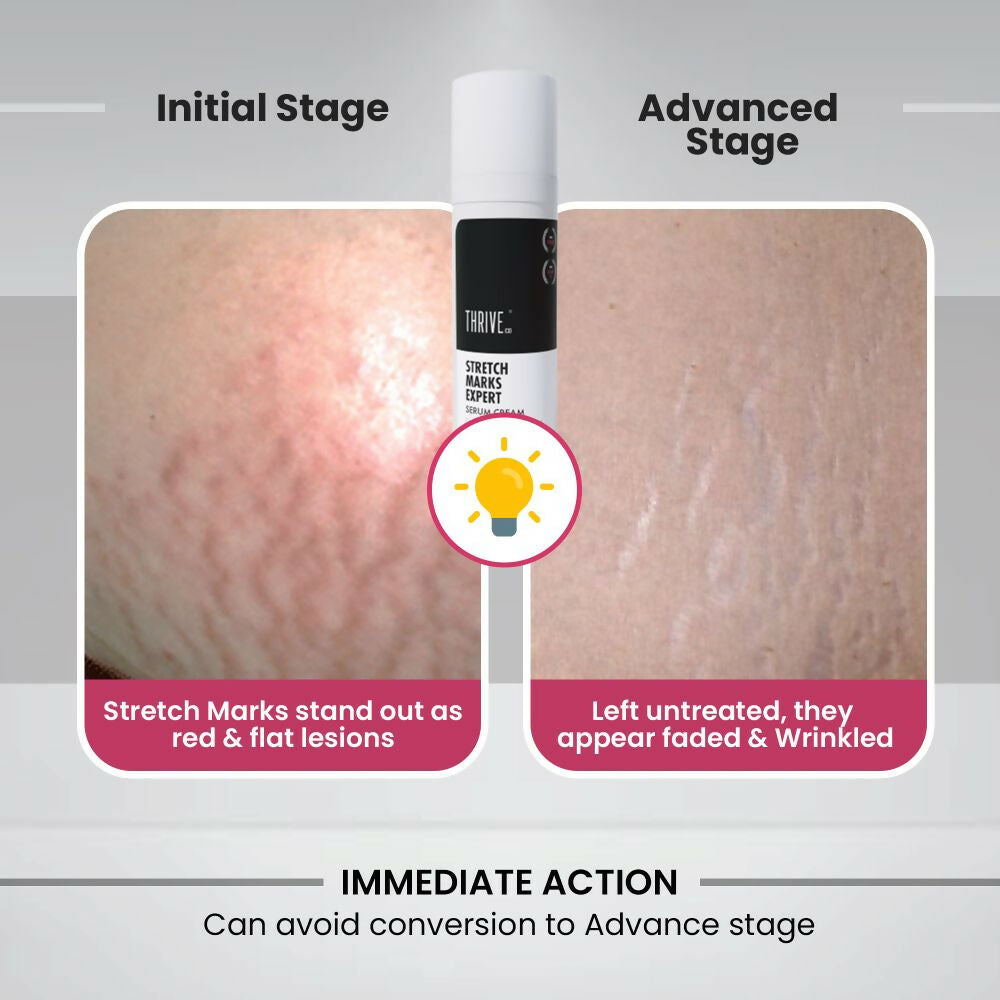 ThriveCo Stretch Marks Expert Serum Cream - Swadesiicart