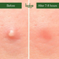 Bake Zit Erase Micro point Patches for Active Acne & Breakouts | Swadesiicart