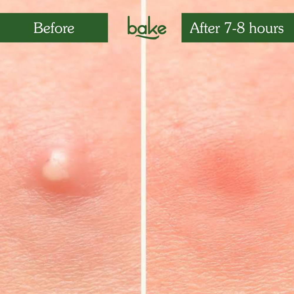 Bake Zit Erase Micro point Patches for Active Acne & Breakouts | Swadesiicart