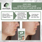 Beauty Secrets Anti Acne Face Mask - Swadesiicart