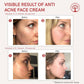 Ivory Natural Acne Face Cream For Acne Free Face | Swadesiicart