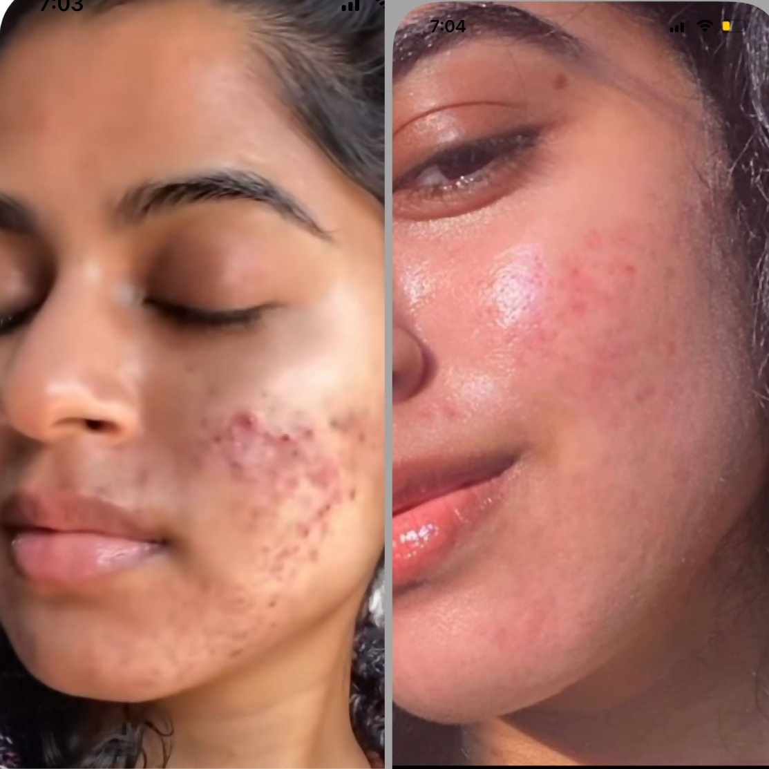 House of Beauty Acne Drying Serum - Swadesiicart